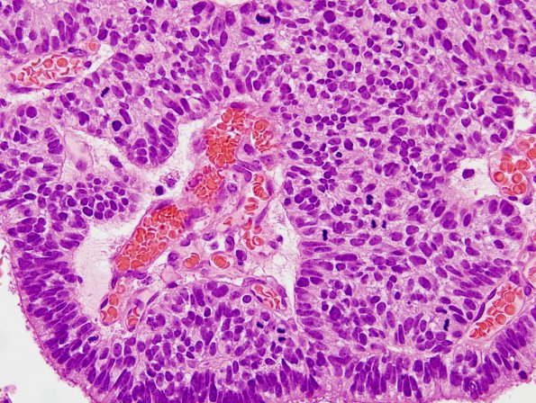 1B4 Choroid Plexus Carcinoma (Case 1) H&E 2