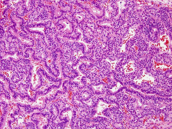 1B5 Choroid Plexus Carcinoma (Case 1) H&E 2