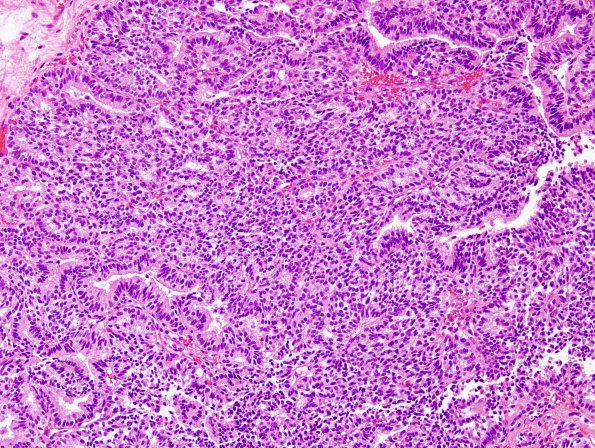 1B6 Choroid Plexus Carcinoma (Case 1) H&E 3