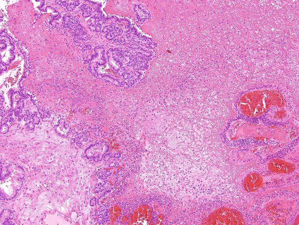 1B7 Choroid Plexus Carcinoma (Case 1) H&E 6