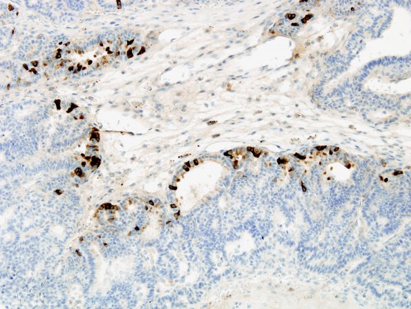 1C Choroid Plexus Carcinoma (Case 1) Transthyretin 4