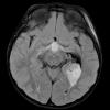 2A1 Choroid Plexus Carcinoma (Case 2) FLAIR 1 - Copy