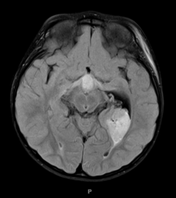 2A1 Choroid Plexus Carcinoma (Case 2) FLAIR 1 - Copy