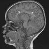 2A2 Choroid Plexus Carcinoma (Case 2) T1 1 copy - Copy