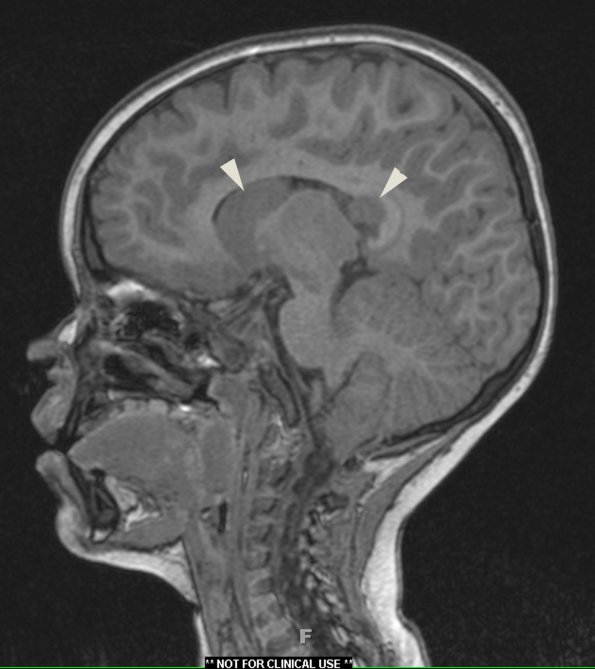 2A2 Choroid Plexus Carcinoma (Case 2) T1 1 copy - Copy