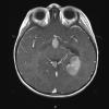 2A3 Choroid Plexus Carcinoma (Case 2) T1W 1 - Copy