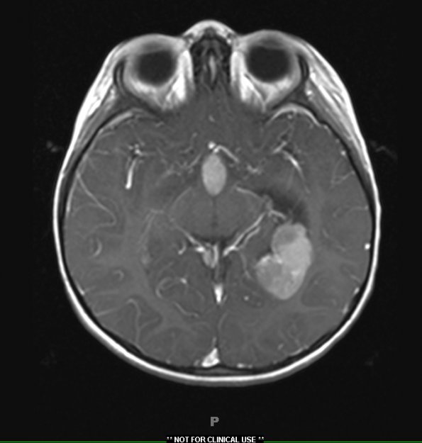 2A3 Choroid Plexus Carcinoma (Case 2) T1W 1 - Copy