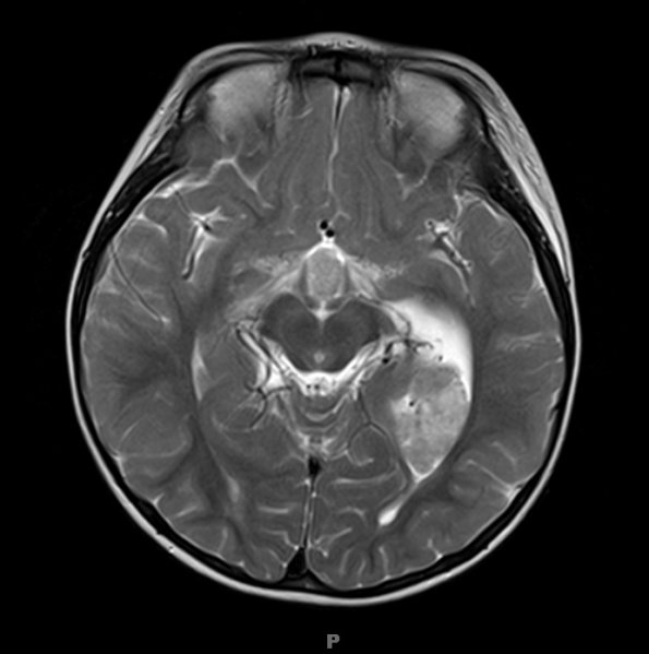 2A4 Choroid Plexus Carcinoma (Case 2) T2 1 - Copy