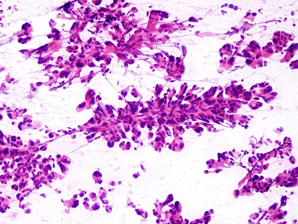 2B1 Choroid Plexus Carcinoma (Case 2) smear H&E 2