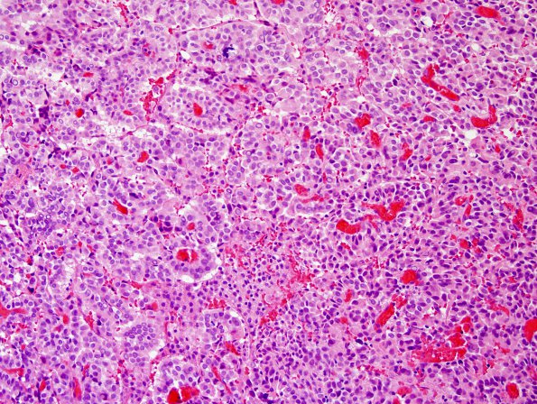 2B2 Choroid Plexus Carcinoma (Case 2) H&E 2