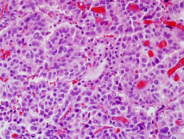 2B3 Choroid Plexus Carcinoma (Case 2) H&E 10