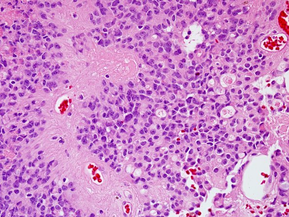 2B5 Choroid Plexus Carcinoma (Case 2) H&E 14.