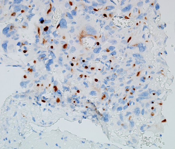 2C1 Choroid Plexus Carcinoma (Case 2) CK 1