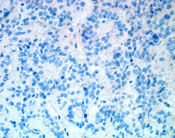 2C2 Choroid Plexus Carcinoma (Case 2) EMA