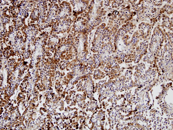 2D1 Choroid Plexus Carcinoma (Case 2) TTR 1