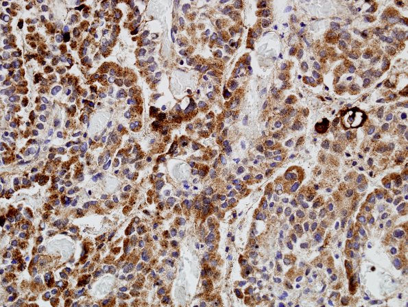 2D2 Choroid Plexus Carcinoma (Case 2) TTR 3