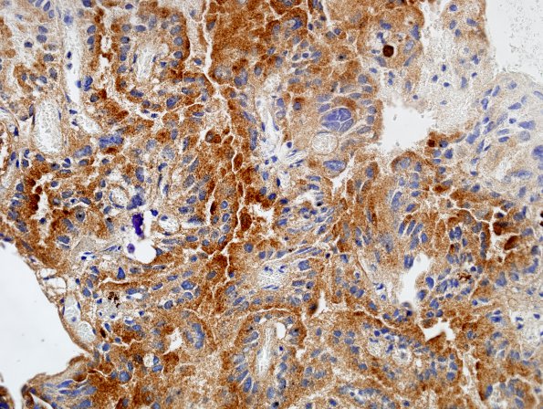 2D3 Choroid Plexus Carcinoma (Case 2) TTR 4