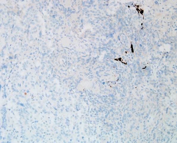 2E1 Choroid Plexus Carcinoma (Case 2) GFAP 1