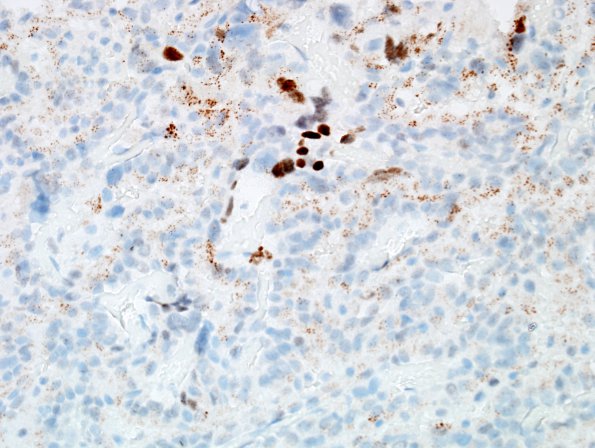 2E2 Choroid Plexus Carcinoma (Case 2) p53