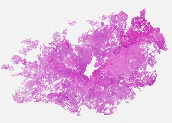 3A1 Choroid Plexus Carcinoma (Case 3) H&E wm