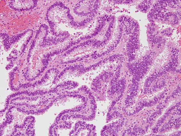 3A2 Choroid Plexus CA (Case 3) H&E 3