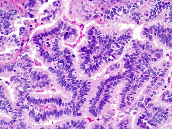 3A4 Choroid Plexus Carcinoma (Case 3) 3.j