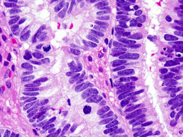 3A5 Choroid Plexus Carcinoma (Case 3) 4