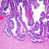 3A6 Choroid Plexus Carcinoma (Case 3) 1.