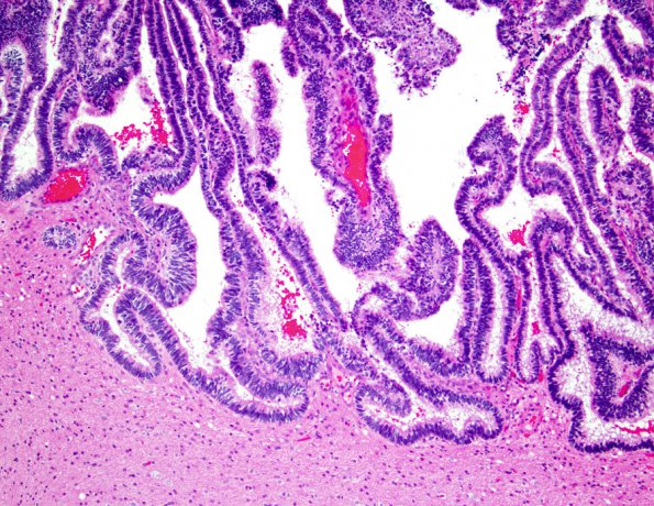 3A6 Choroid Plexus Carcinoma (Case 3) 1.