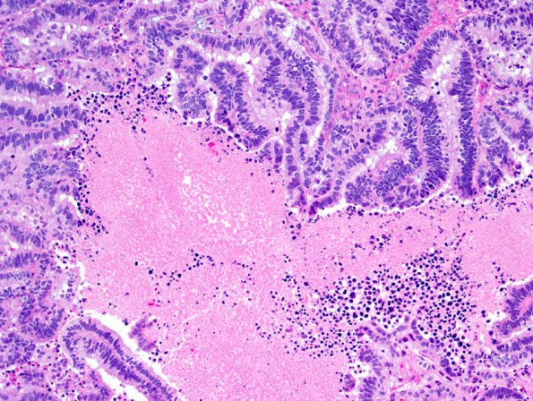 3A7 Choroid Plexus Carcinoma (Case 3) 6.jpg