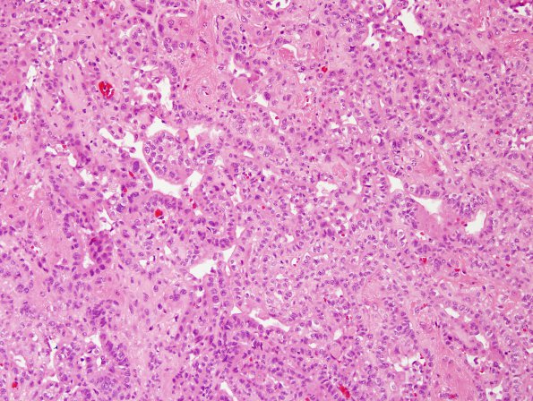 3A8 Choroid Plexus Carcinoma (Case 3) H&E 1