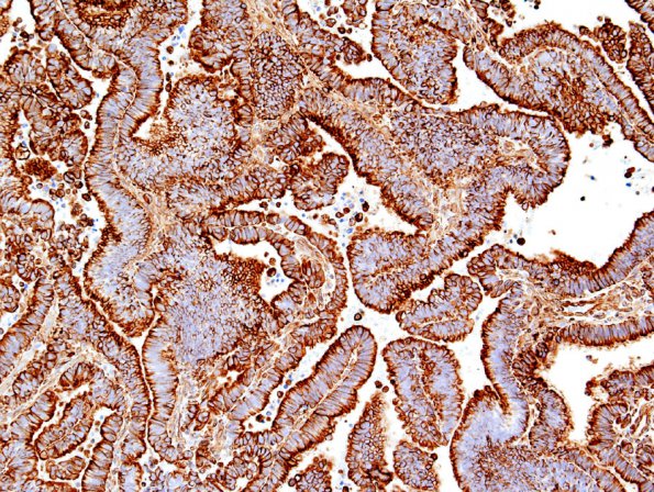 3B Choroid Plexus Carcinoma (Case 3) VIM.jpg