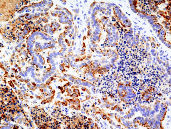 3C1 Choroid Plexus Carcinoma (Case 3) CK 1.jpg