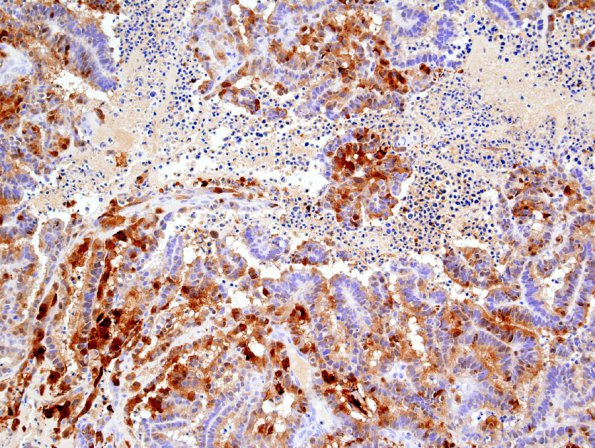 3D Choroid Plexus Carcinoma (Case 3) S-100