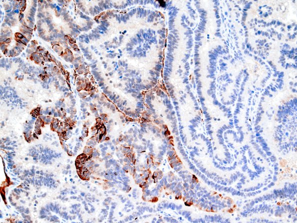 3E1 Choroid Plexus Carcinoma (Case 3) GFAP.jpg