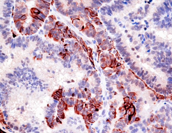 3E2 Choroid Plexus Carcinoma (Case 3) GFAP 2.jpg