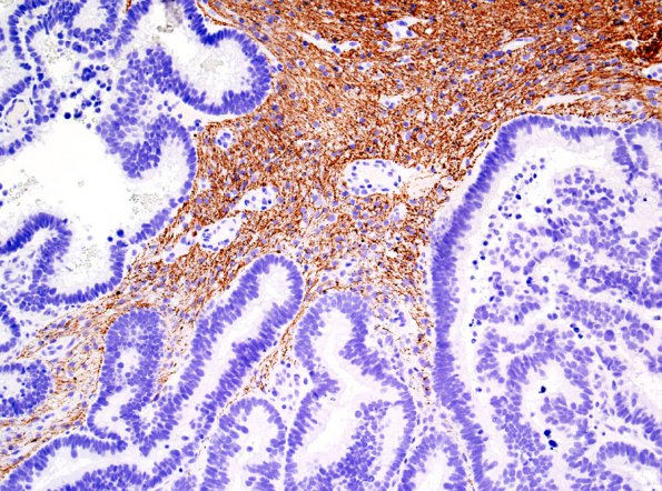 3F Choroid Plexus Carcinoma (Case 3) NF.jpg