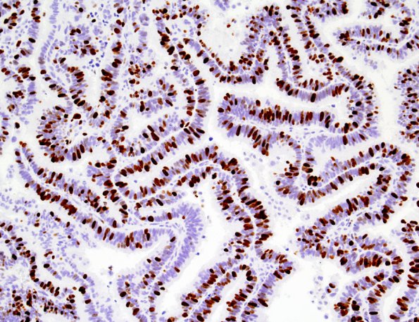 3G1 Choroid Plexus Carcinoma (Case 3) MIB1 1.jpg