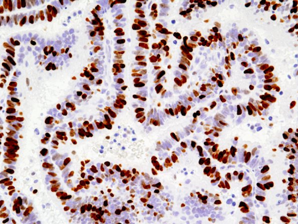 3G2 Choroid Plexus Carcinoma (Case 3) MIB1 2.jpg