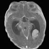 4A Choroid plexus carcinoma (Case 4) T1 with contrast 2 - Copy