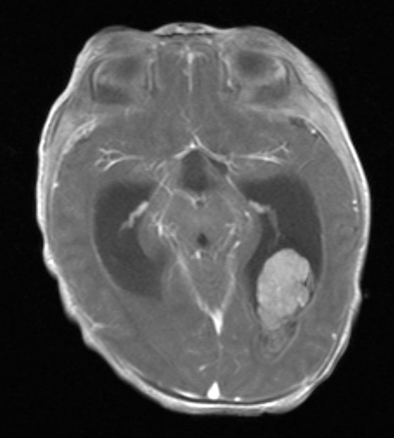 4A Choroid plexus carcinoma (Case 4) T1 with contrast 2 - Copy