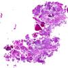 4B1 Choroid Plexus Carcinoma (Case 4) H&E WM