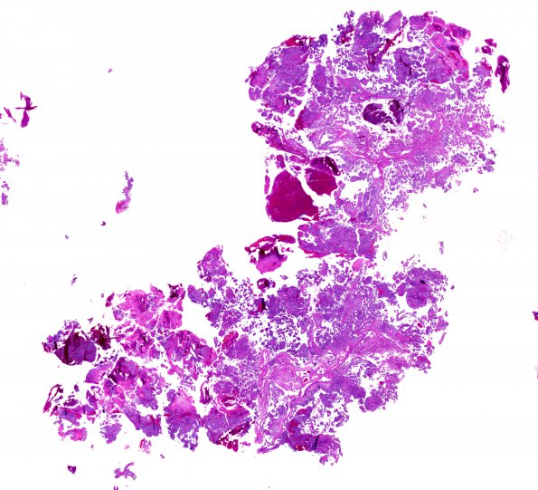 4B1 Choroid Plexus Carcinoma (Case 4) H&E WM