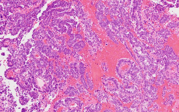 4B2 Choroid Plexus Carcinoma (Case 4) H&E 5