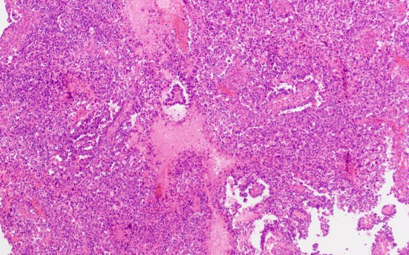 4B3 Choroid Plexus Carcinoma (Case 4) H&E 1