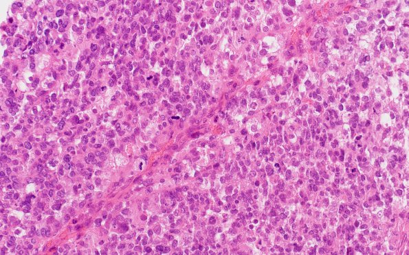 4B4 Choroid Plexus Carcinoma (Case 4) H&E 2