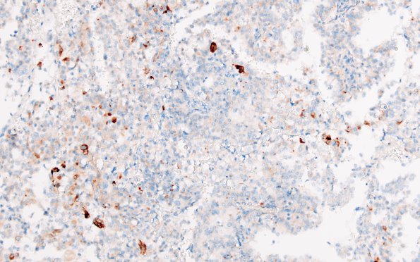 4C Choroid Plexus Carcinoma (Case 4) CK 20X