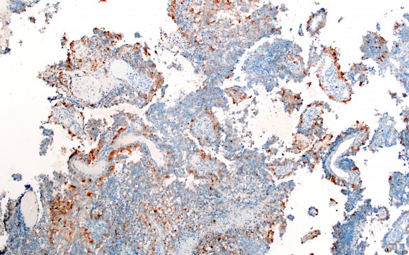 4D1 Choroid Plexus Carcinoma (Case 4) S100 1