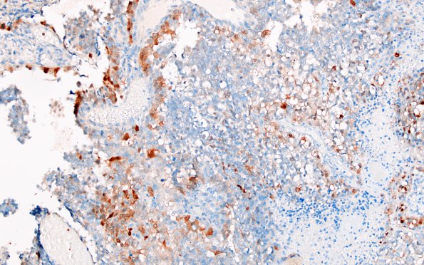 4D2 Choroid Plexus Carcinoma (Case 4) S100 2