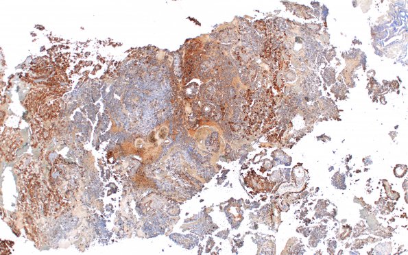 4E1 Choroid Plexus Carcinoma (Case 4) Transthyretin 1